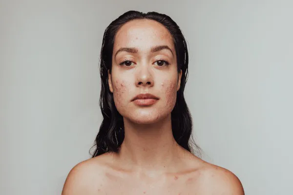 Rethinking Acne