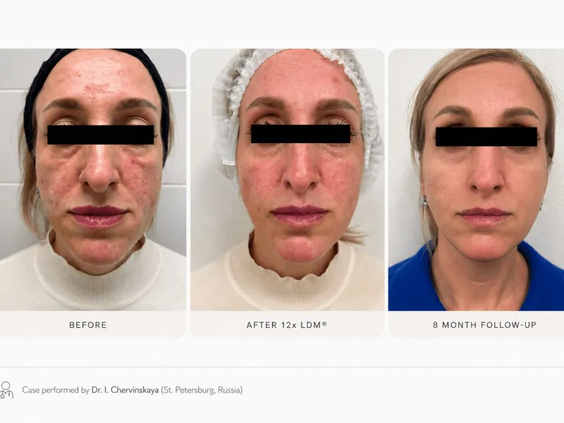 11.5% of UK adults have active acne right now