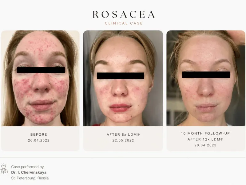 From active acne to scarring to long-term skin health