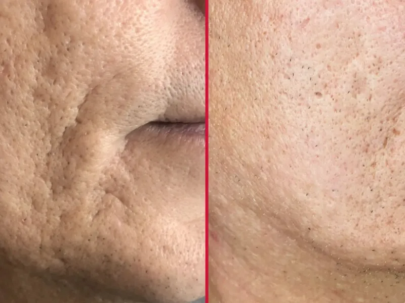 Two of the most-asked-about skin concerns, covered by one device