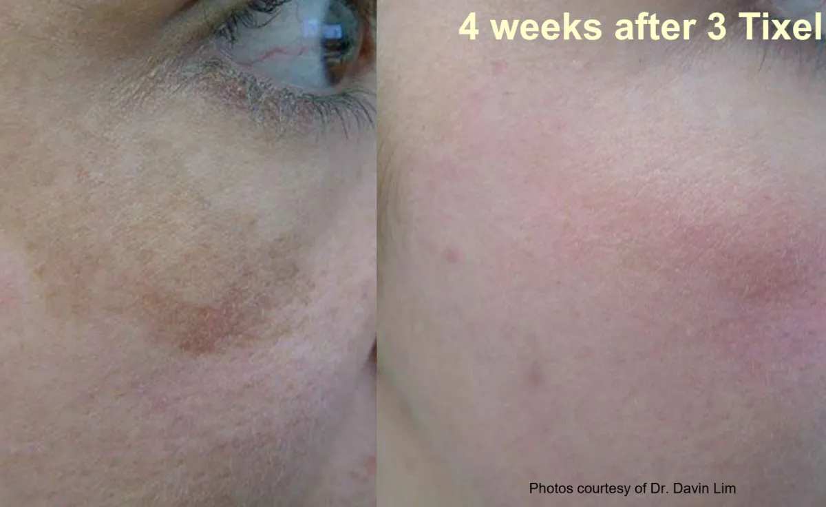 Melasma
