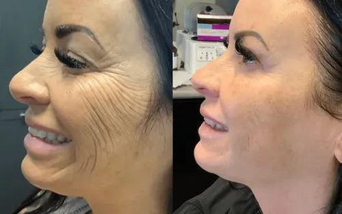 Before And After Morpheus8 Photos Image