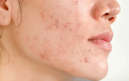 Morpheus8 For Acne Scarring Image