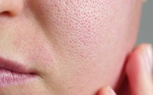 Morpheus8 For Enlarged Pores Image