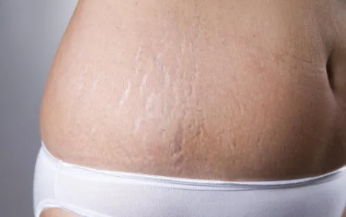 Morpheus8 For Stretch Marks Image
