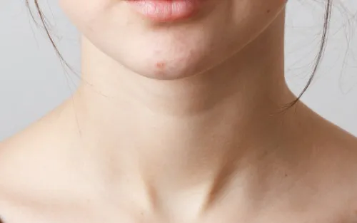 Morpheus8 For The Neck Image