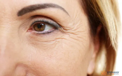 Morpheus8 For Wrinkles Image