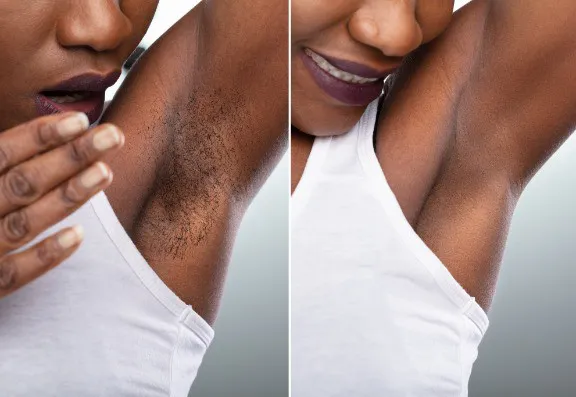 Soprano Laser Hair Removal