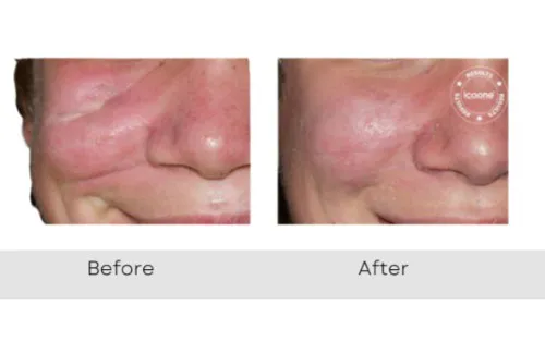 Icoone Before And After Images Image