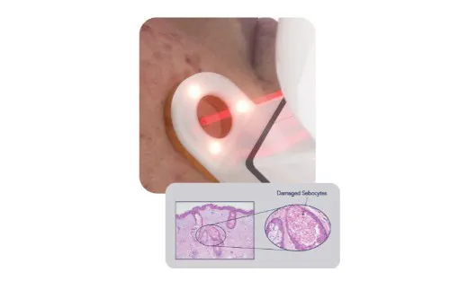 AviClear