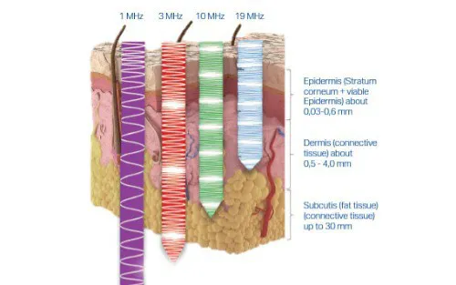 LDM® Triple ultrasound work? Image