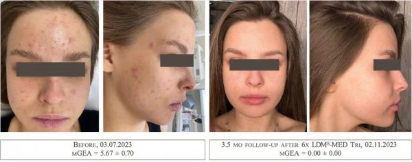 LDM Triple Acne Results