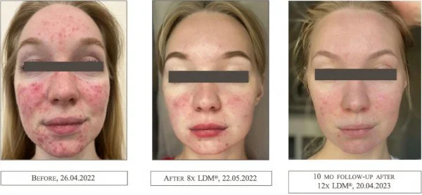 Rosacea Treatment