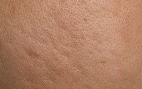 For Acne Scars Image