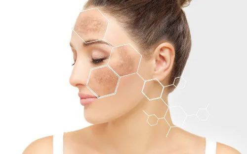 Hyperpigmentation Image