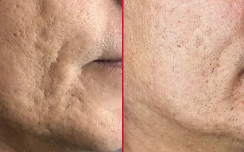 Can Laserme Treat? Image