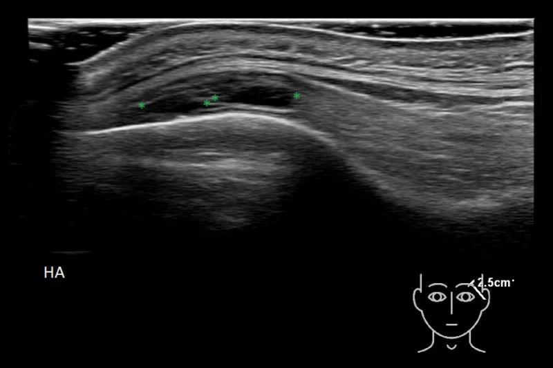 Close-up of a syringe containing hyaluronidase enzyme solution positioned beside an ultrasound screen showing a small filler deposit highlighted, clean clinical still-life photography style