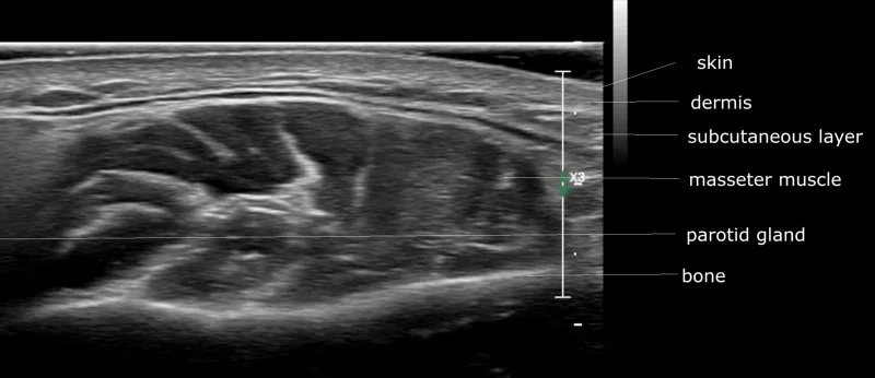 Comparison image showing facial skin surface alongside an ultrasound scan of the tissue beneath