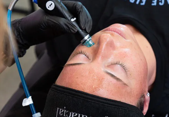 How Effective Is Hydrafacial Treatment for Rosacea?