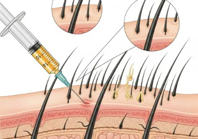 PRP For Hair Loss