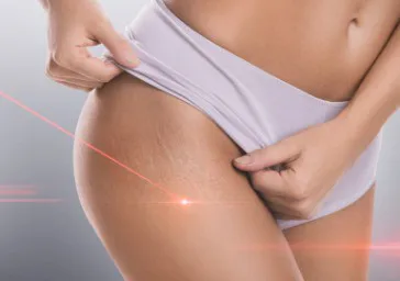 Acoustic Wave Therapy For Cellulite clinics