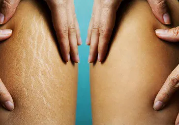 Carboxytherapy clinics