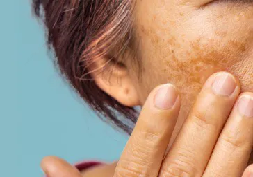 Dermabrasion clinics