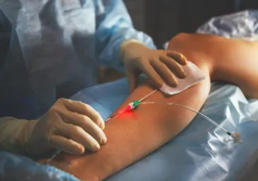 Endovenous Laser Ablation (EVLA/EVLT)