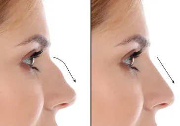 Rhinoplasty