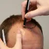 Scalp Reduction Surgery