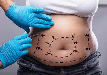 Abdominoplasty (Tummy Tuck)