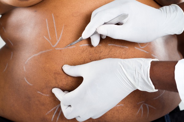 Tummy Tuck or Abdominoplasty Cosmetic Surgery Image