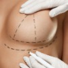 Breast Lift