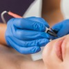 Electrolysis (Advanced Cosmetic Procedures)