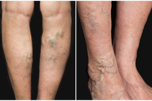 EVLA / EVLT - Endovenous Laser Ablation Treatment For Varicose Veins Information Image