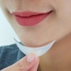 Facial Implants (Cheek and Chin)