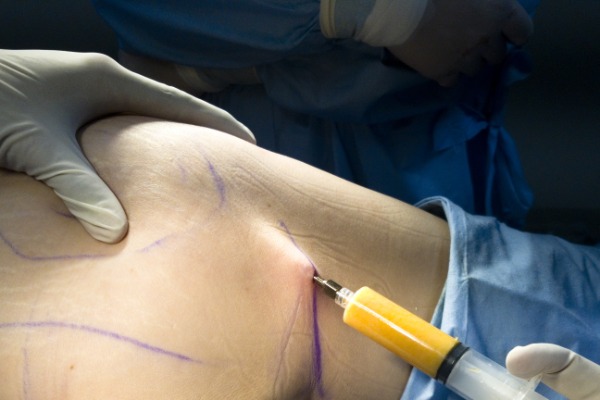Fat Transfer, Fat Transplantation or Microlipoinjection Information Image