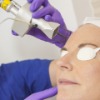 Fractional Laser Skin Resurfacing