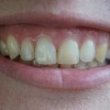 Gum Contouring (Teeth)