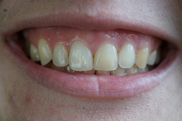 Gum Contouring (Teeth) Information Image