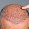 Hair Transplant Surgery