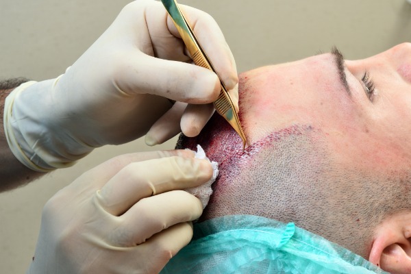 Hair Transplant Surgery Information Image