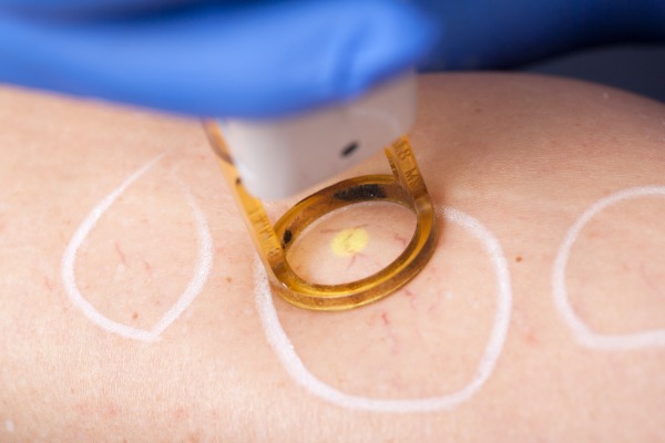 Laser & IPL Treatment - Pigmented and Vascular Problems Information Image