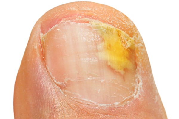 Toenail Fungus Treatment Using Laser Technology | Cold Laser Nail Clinic