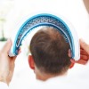 Laser Hair Loss Therapy