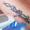 Laser Tattoo Removal