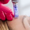 Medical Skin Needling