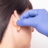 Otoplasty (Cosmetic Ear Surgery/Pinning)