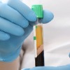 Platelet Rich Plasma (PRP) Therapy