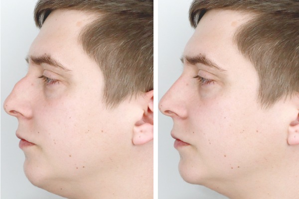 Cosmetic Rhinoplasty or Nose Job Information Image